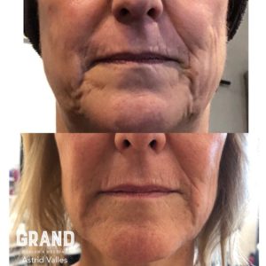 Filler before and after